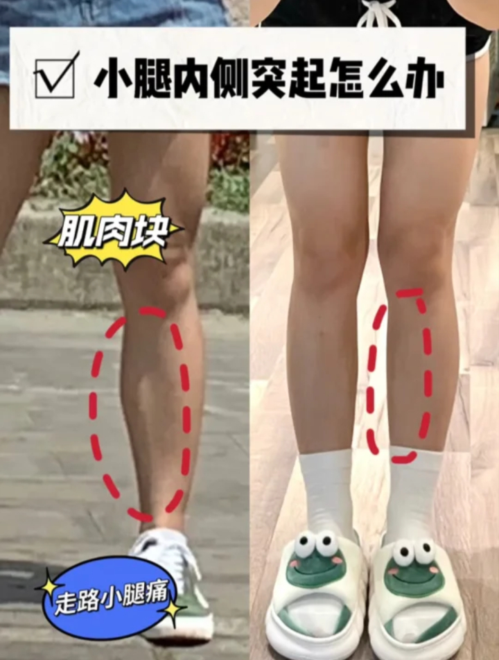 小腿内侧鼓包肌肉块严重看这一篇就够了