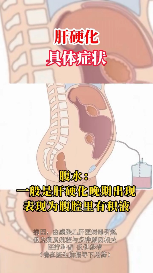 肝硬化后期的症状表现是什么?