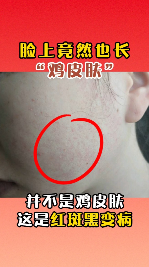 脸上竟然也长“鸡皮肤”