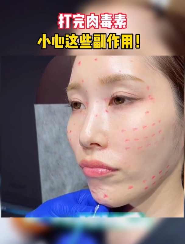 打完肉毒素,小心这些副作用!