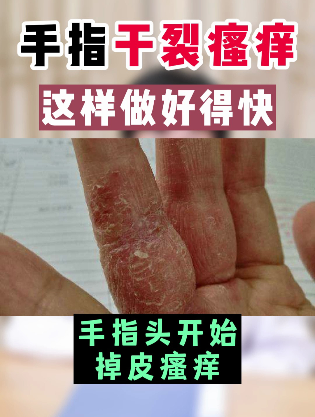 건조한 손 손과 손가락의 피부 벗겨짐 공기 알레르기 화학 물질 알레르기피부염 습진 | 프리미엄 사진