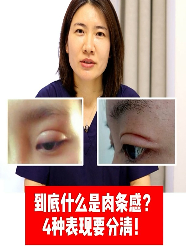 肉条双眼皮怎么回事 肉条双眼皮四种表现
