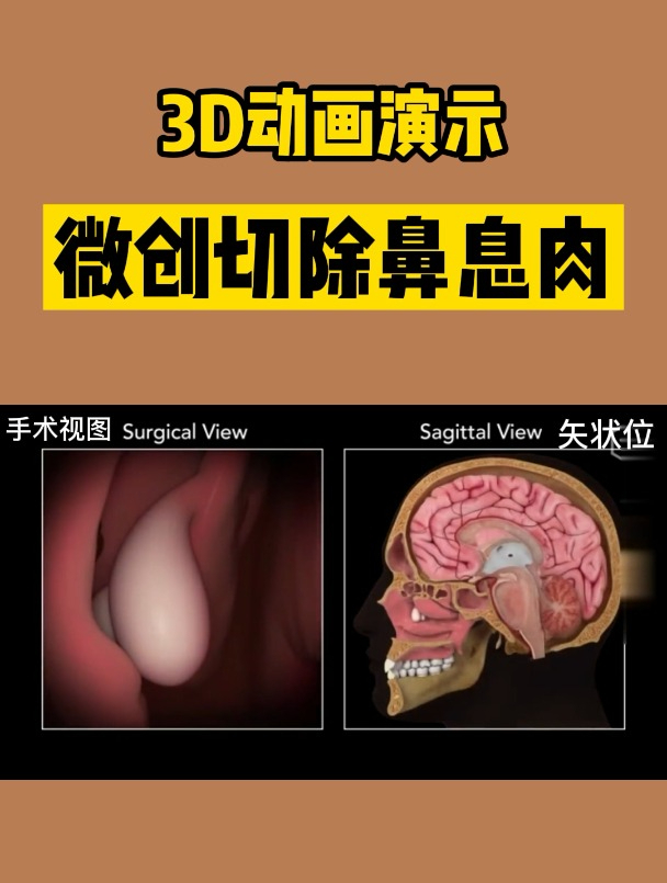 微创切除鼻息肉(3D动画演示)