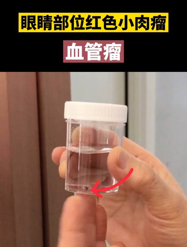 眼睛部位红色小肉瘤