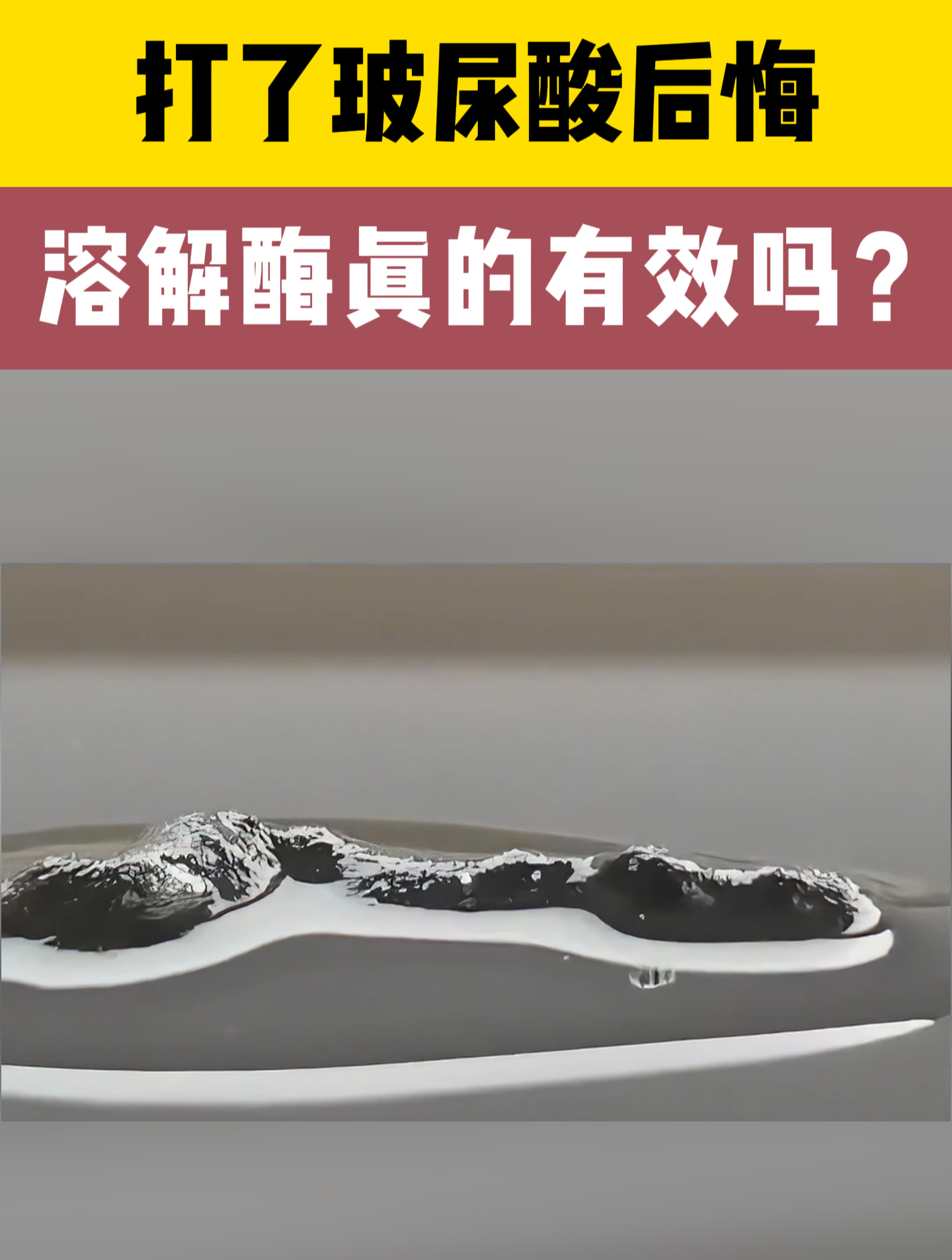 玻尿酸可逆吗?皮肤科医生:可以用溶解酶!