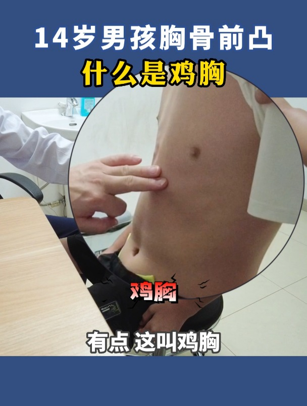 14岁男孩胸骨前凸畸形,什么是鸡胸?鸡胸会造成什么后果?