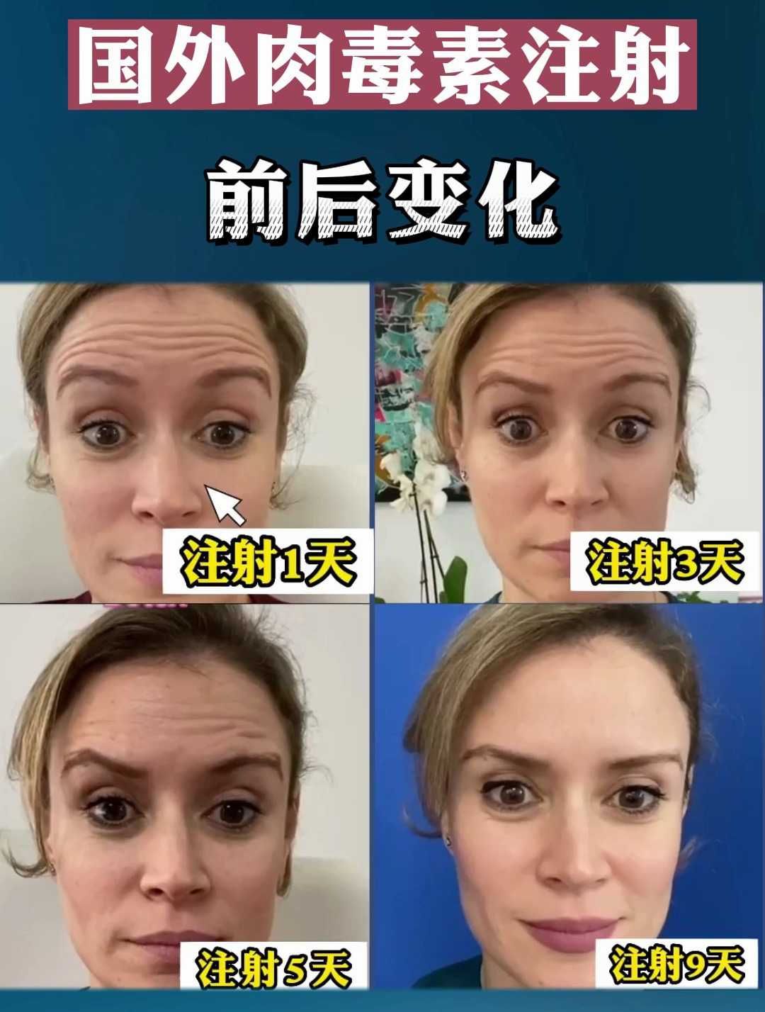 国外肉毒素注射前后变化