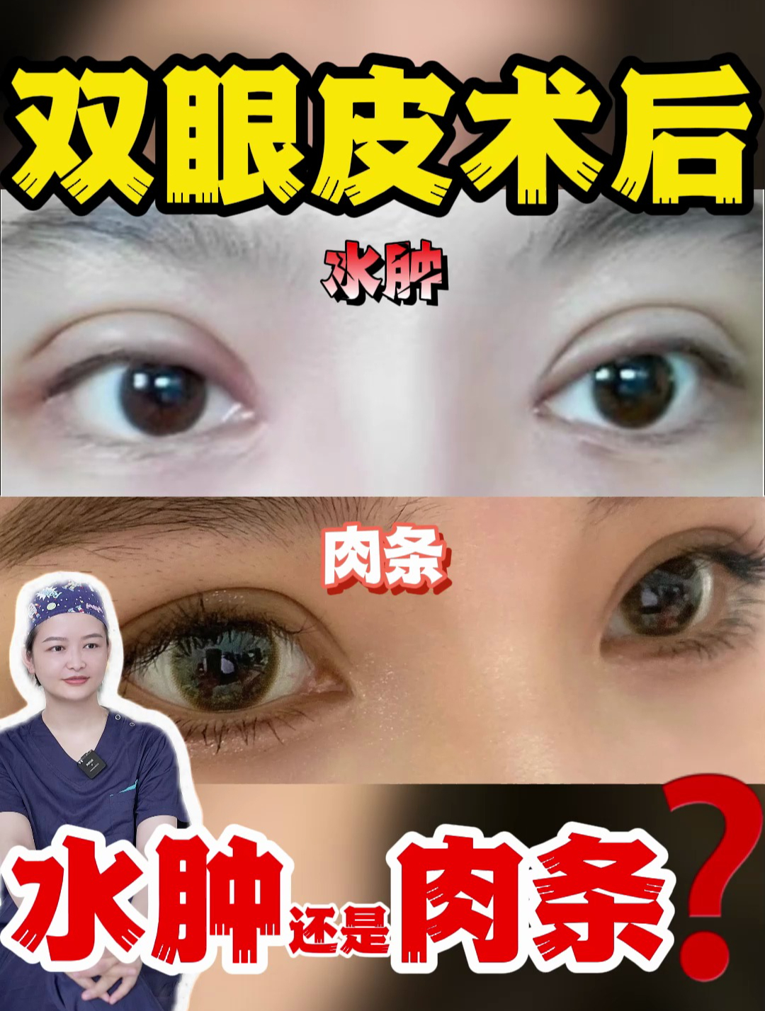 双眼皮术后怎么判断水肿还是肉条