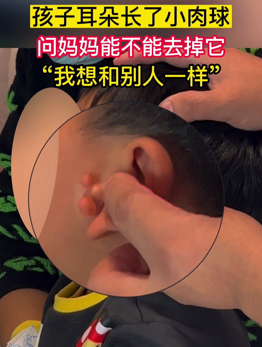 孩子耳朵上长了几个小肉球,不想和别人不一样