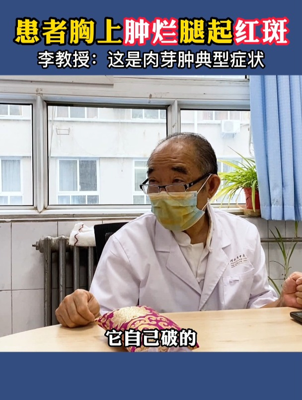 患者胸上红肿溃烂,腿上还起红斑,这是肉芽肿典型症状