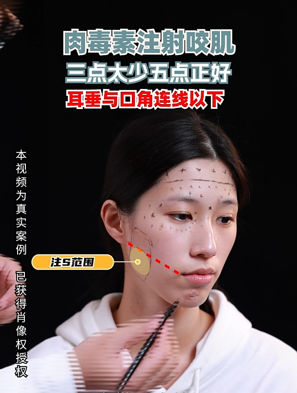 肉毒素注射:瘦咬肌打几个点也是很有讲究的!