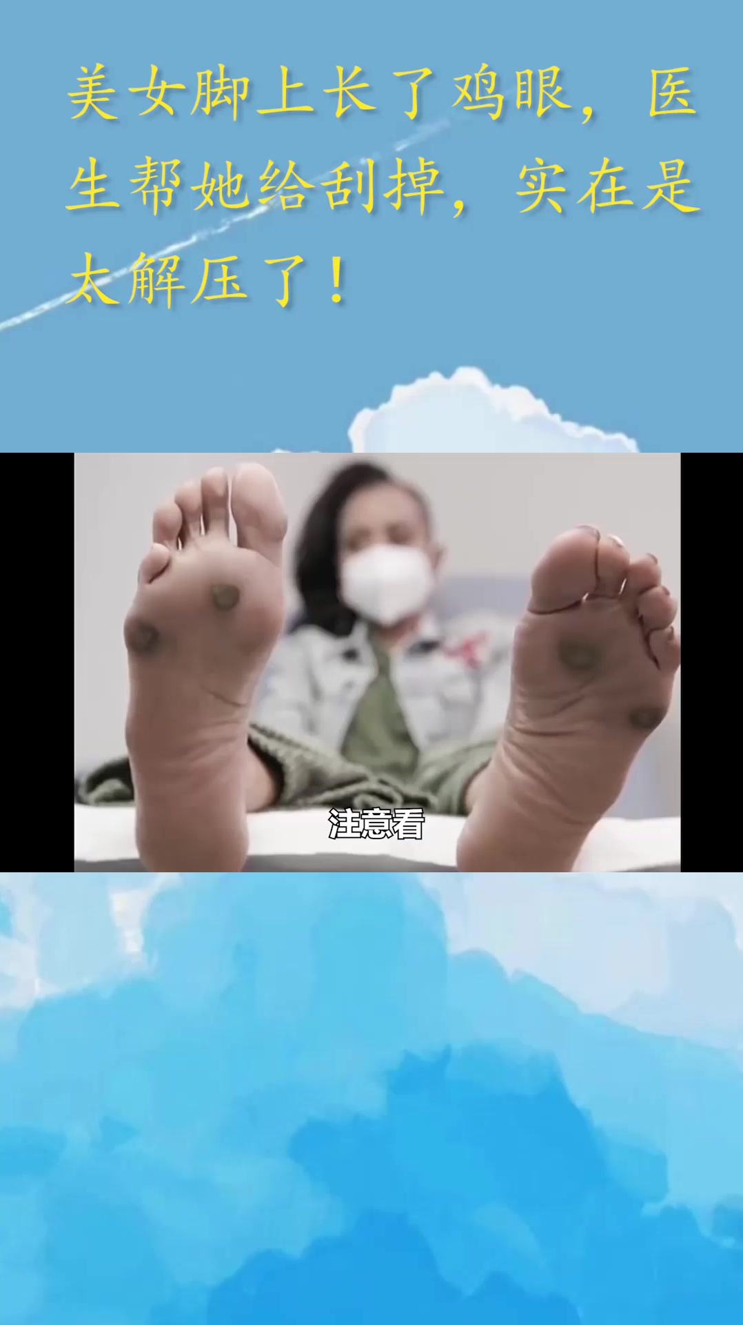 美女脚上长了鸡眼,医生帮她给刮掉,实在是太解压了!