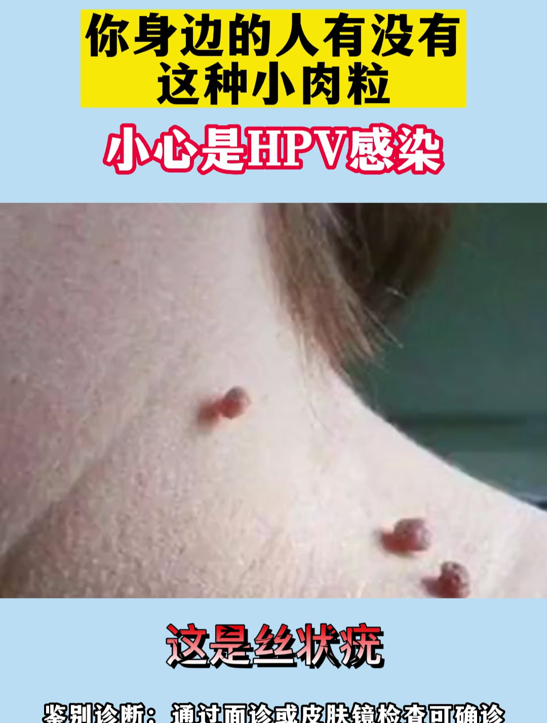 你身边有人长这种小肉粒吗?