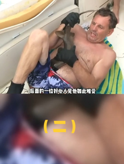 国外老哥的肚子,被鲨鱼咬上了(二)