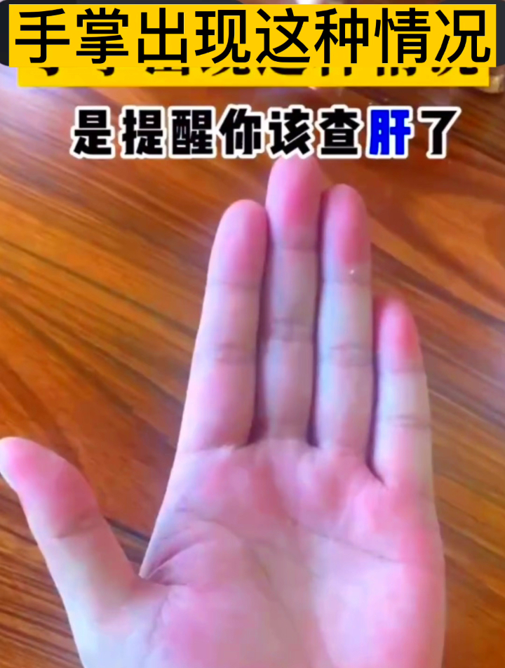 手掌出现这种情况是提醒你该查肝了