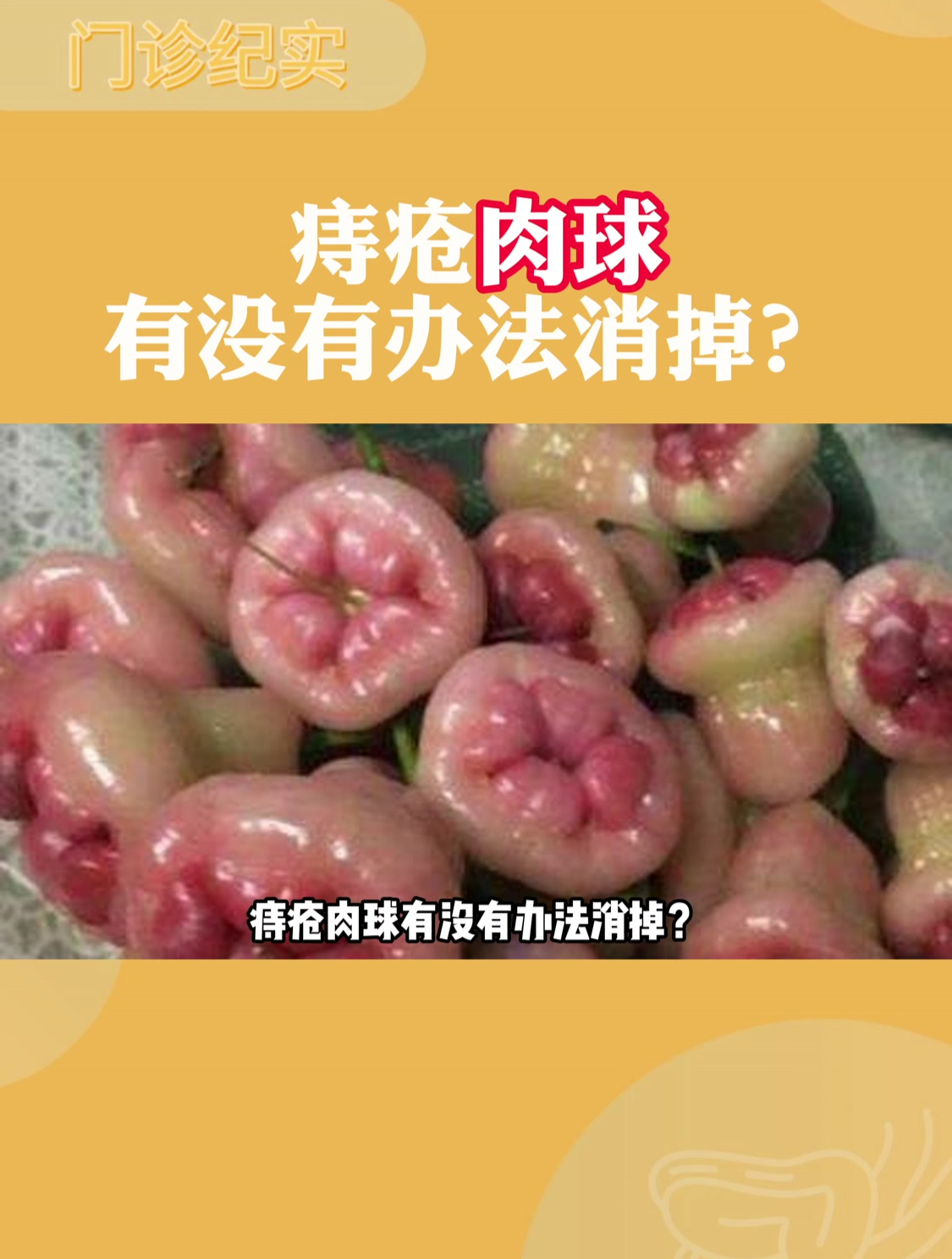 屁股上的痔疮肉球有没有办法消掉