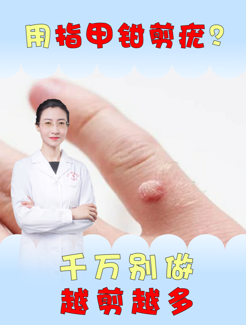 手上长“瘊子”,剪掉就好了?医生:不想越长越多,千万别剪!