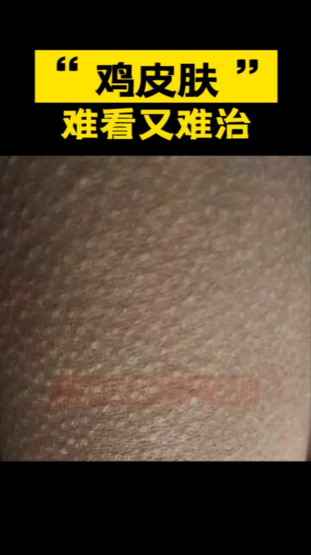 “鸡皮肤”难看又难治 怎么处理?