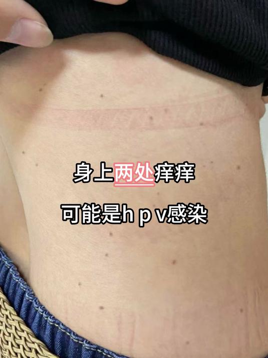 身上两处痒痒,可能是hpv感染