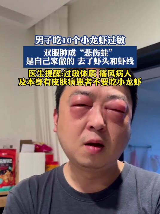 男子吃10个小龙虾过敏,双眼肿成“悲伤蛙”