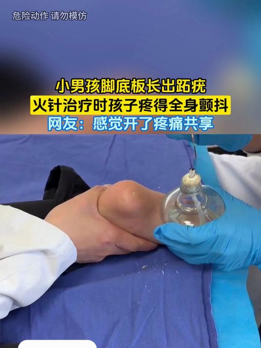 小男孩脚底板长出跖疣,火针治疗时孩子疼得全身颤抖,网友:感觉开了疼痛共享