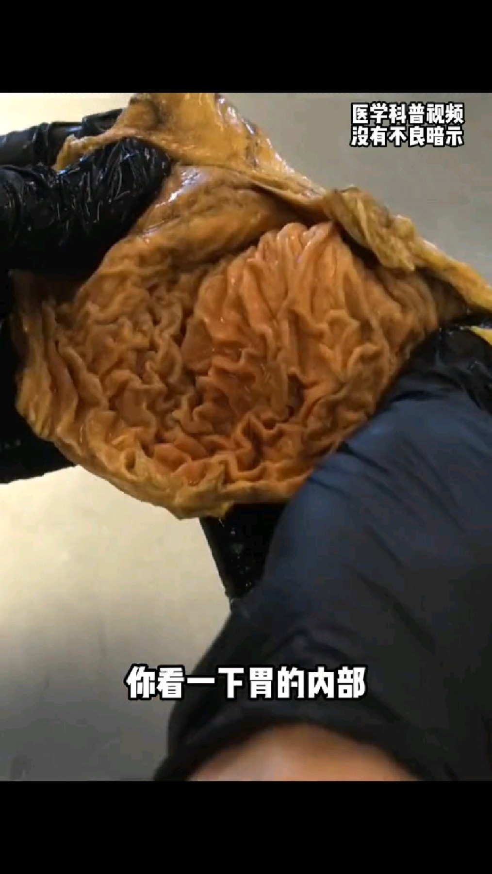 胃皱襞大体解剖