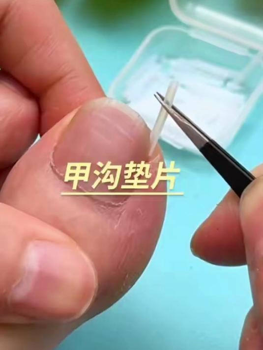 嵌甲分离片,指甲不会再往肉陷,好似垫棉花特舒坦!