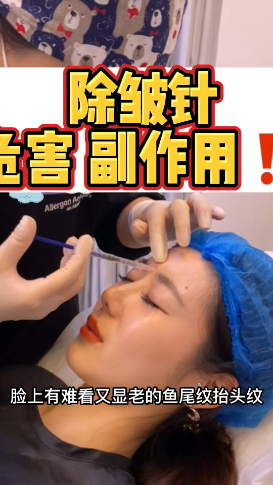 肉毒素除皱的副作用有多厉害?如何能避免危害我的经验!