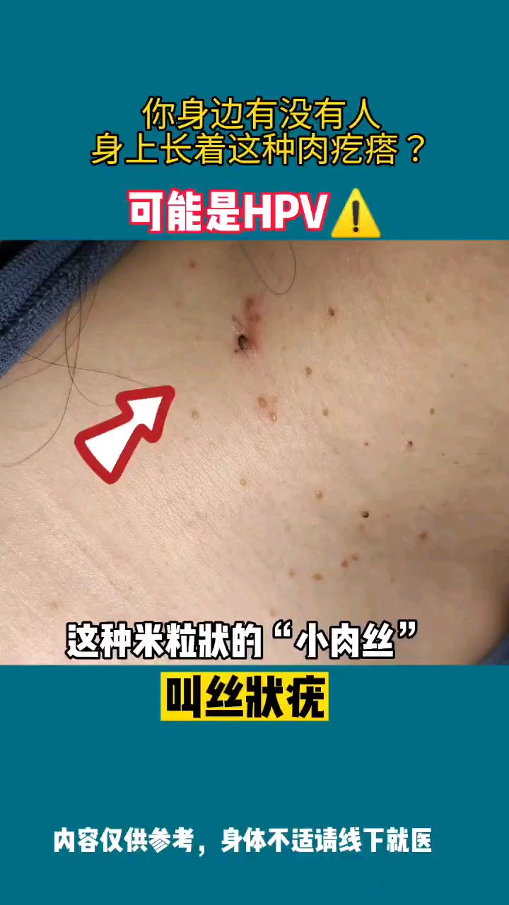 你身边有没有人,身上长着这种肉疙瘩?注意了!