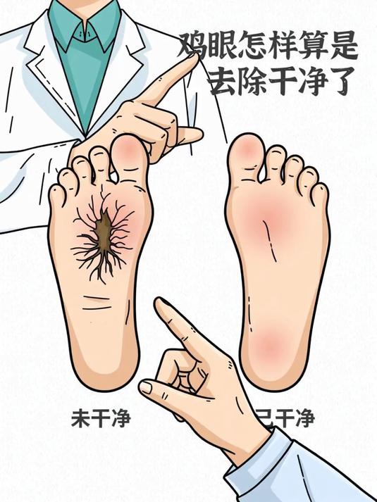 鸡眼怎样算是去除干净了 #健康扬帆季#