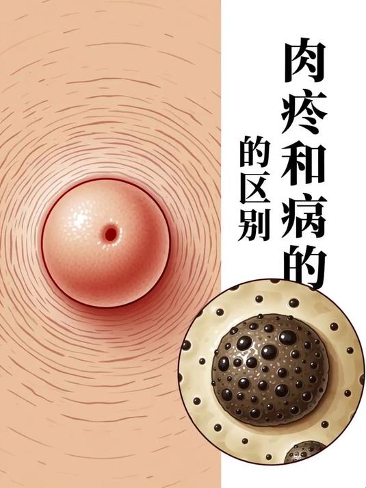 肉痣和疣的区别