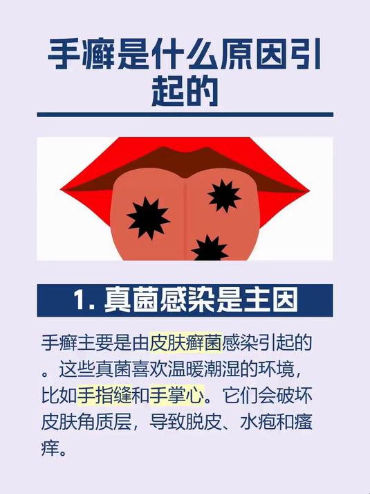 手癣是什么原因引起的