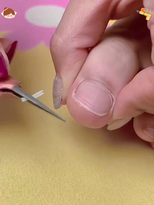 嵌甲分离片太妙!指甲不再往肉里钻,如垫棉花自在无烦忧