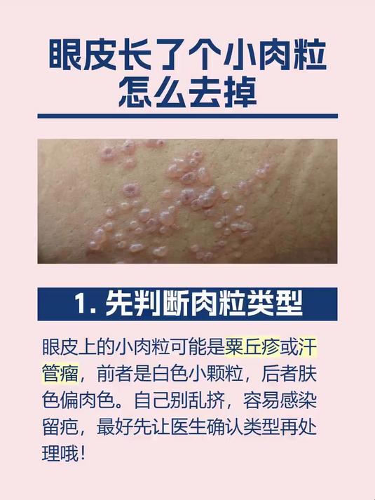 眼皮长了个小肉粒怎么去掉