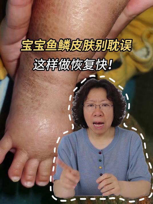 宝宝鱼鳞皮肤别耽误!这样做恢复快!