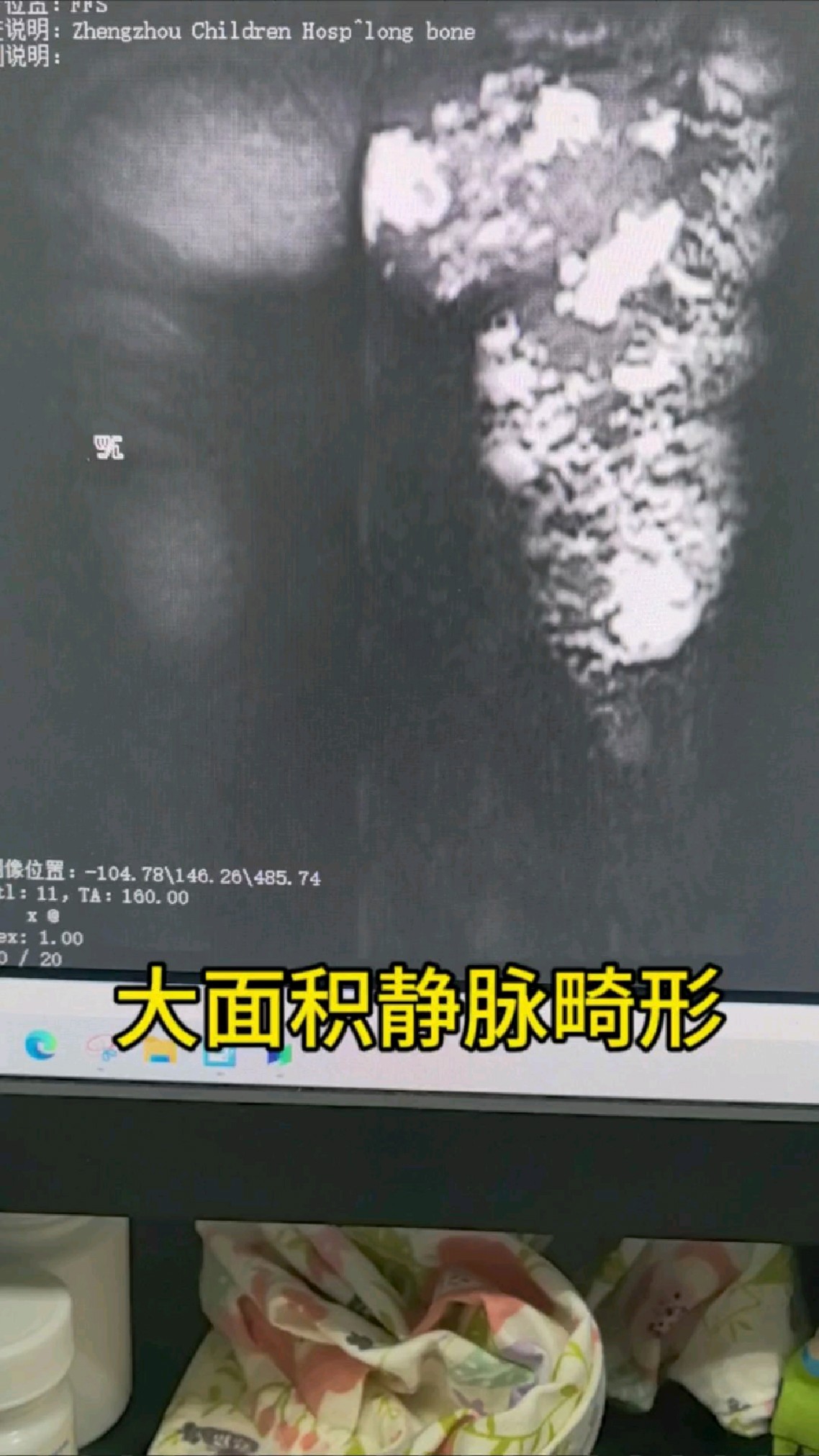 男童阴囊静脉畸形和广泛下肢静脉畸形怎么治疗?