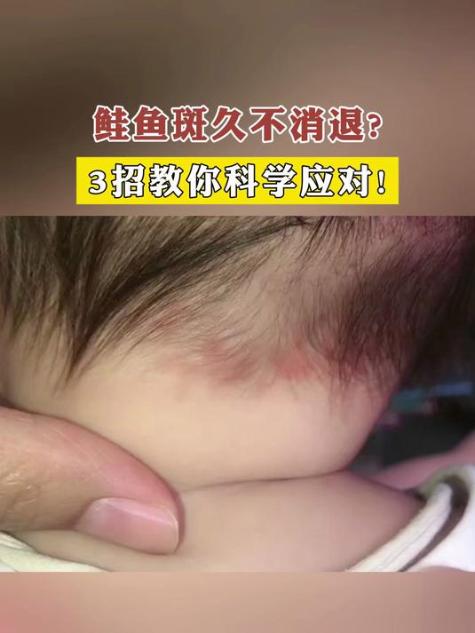 鲑鱼斑久不消退?3招教你科学应对!