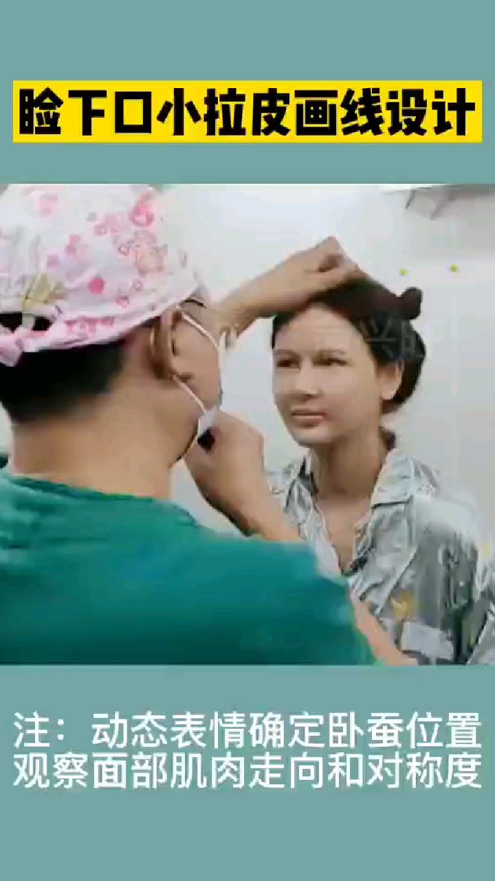 睑下口小拉皮画线设计,动态观察面部肌肉走向和对称度。