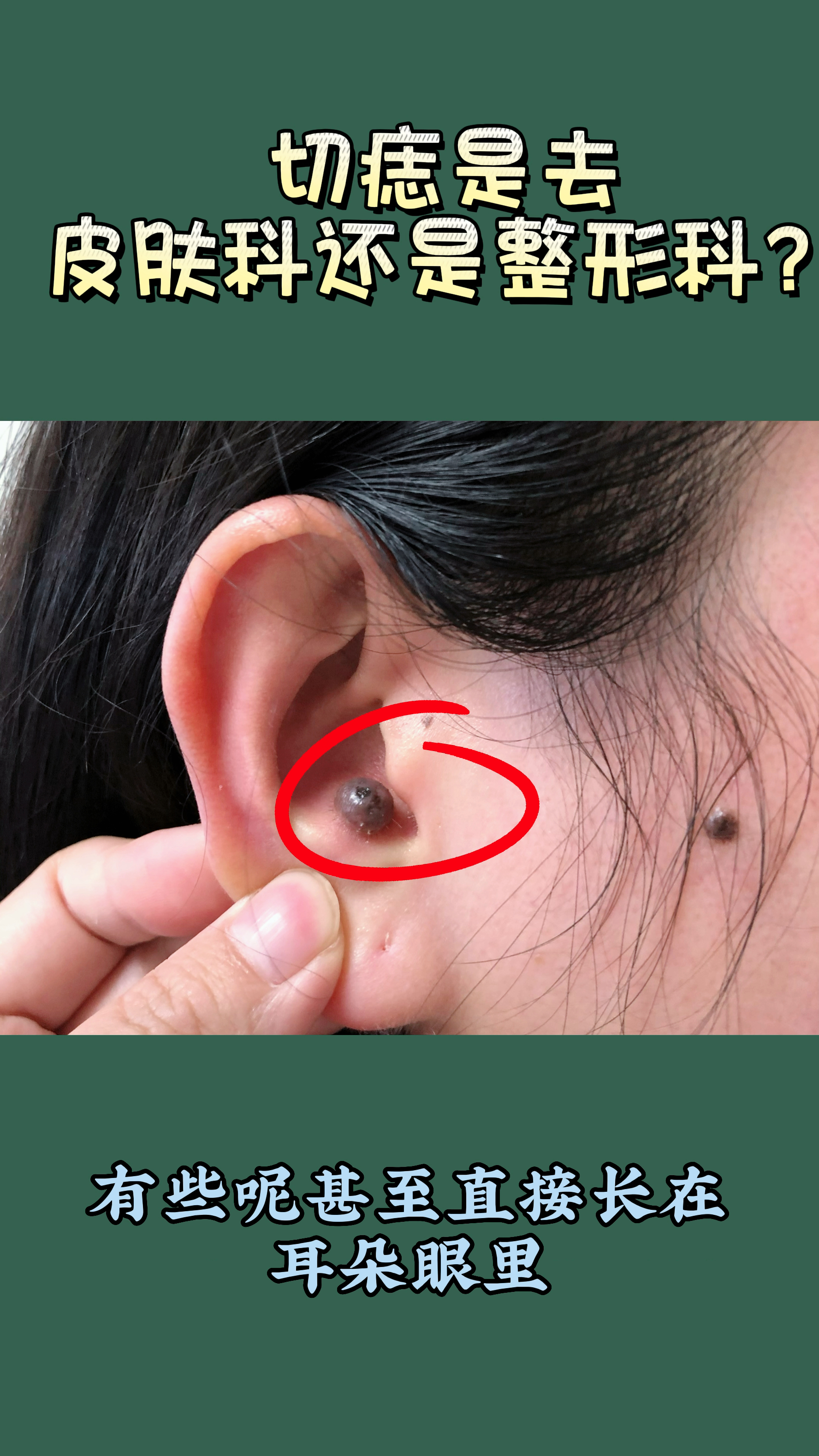 色素痣切除去哪个科?