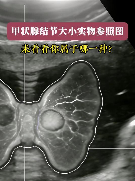 甲状腺结节大小实物参照图,你属于哪一种?
