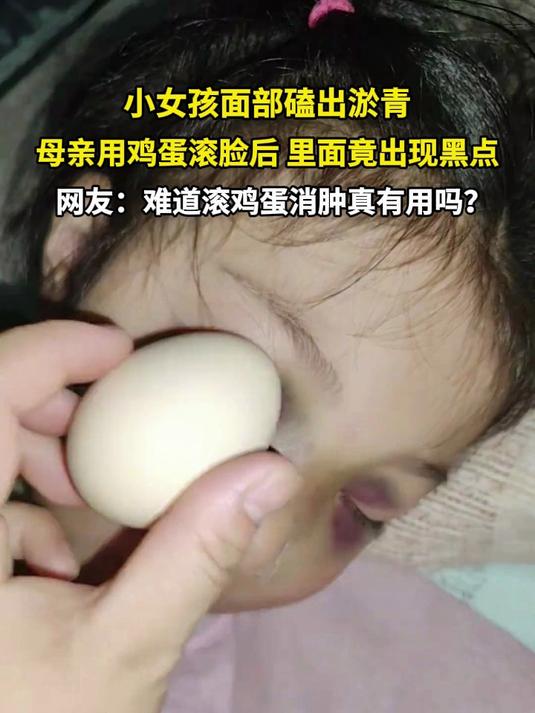 小女孩面部磕出淤青 母亲用鸡蛋滚脸后惊现黑点 网友：难道滚鸡蛋消肿真有用吗？