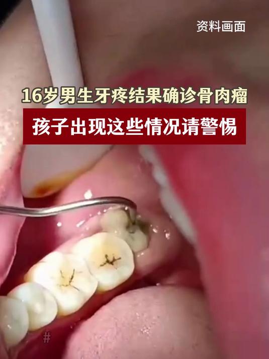 16岁男生牙疼确诊骨肉瘤,孩子出现这些情况请警惕~