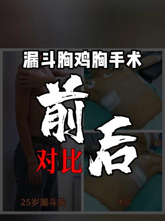 漏斗胸鸡胸手术前后对比