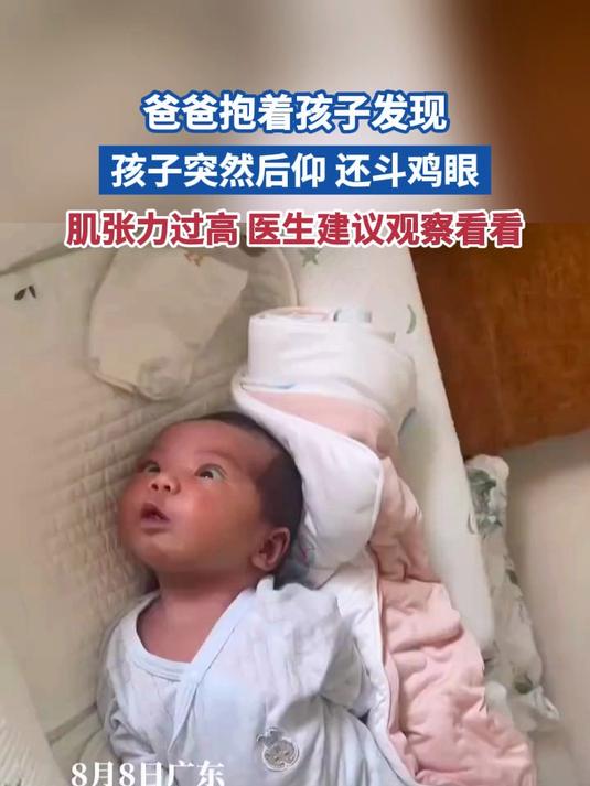 爸爸抱孩子发现孩子突然后仰斗鸡眼 肌张力过高 医生建议观察看看