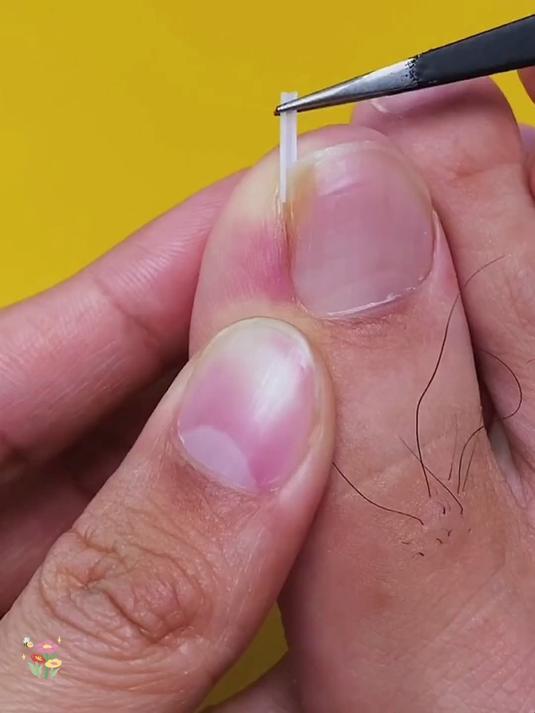 嵌甲分离片真管用,指甲不再扎肉里,垫着棉花般舒服!