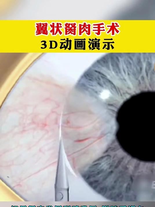 翼状胬肉手术!
