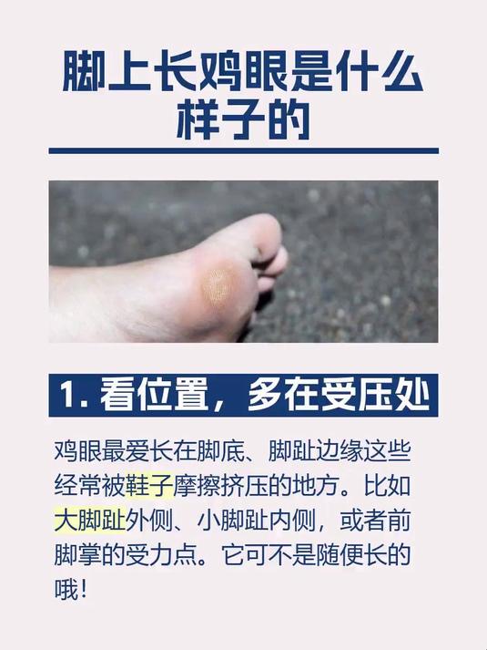 脚上长鸡眼是什么样子的