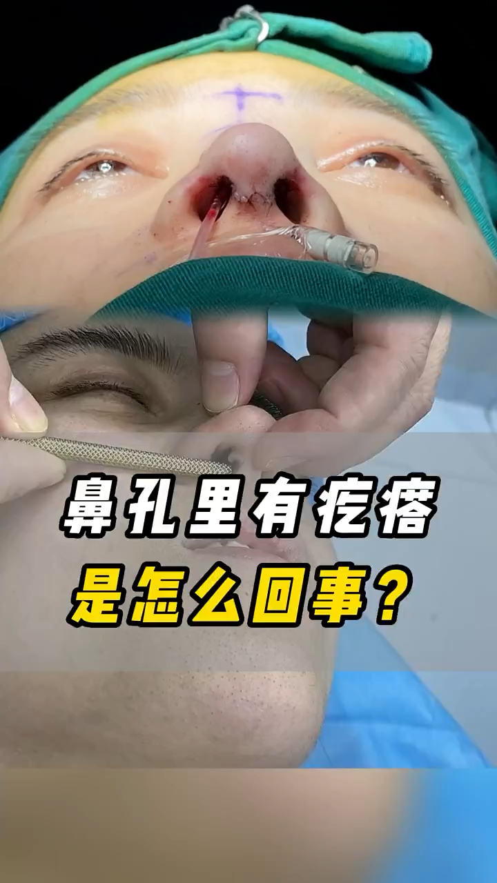 鼻孔里有疙瘩是怎么回事?