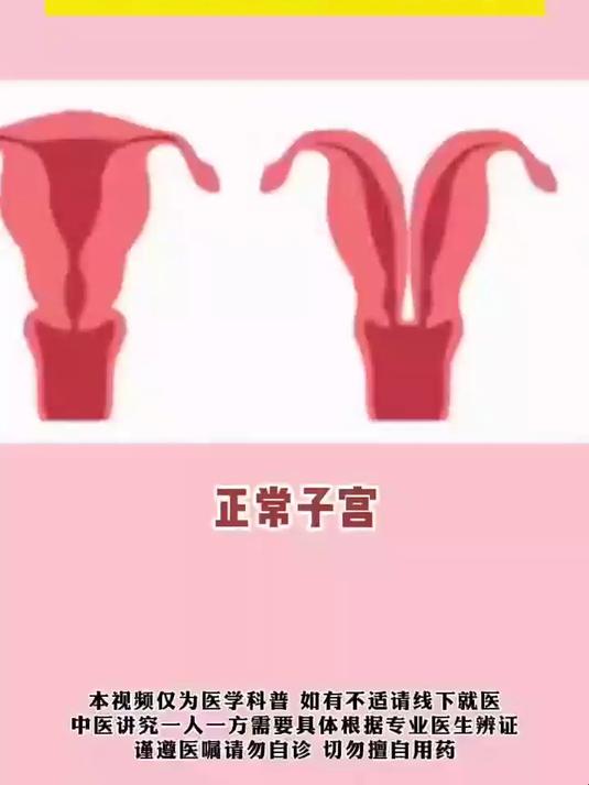 子宫的各种形状