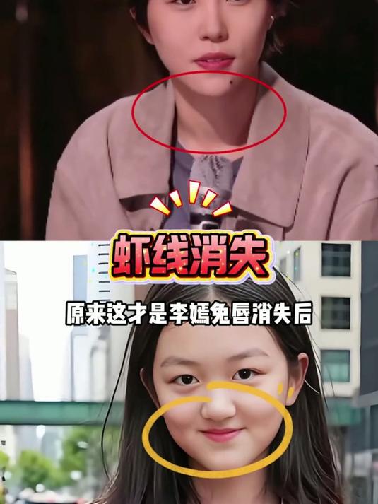 李嫣兔唇消失后窦靖童虾线同步消失，揭秘姐妹血脉相连的深情守护